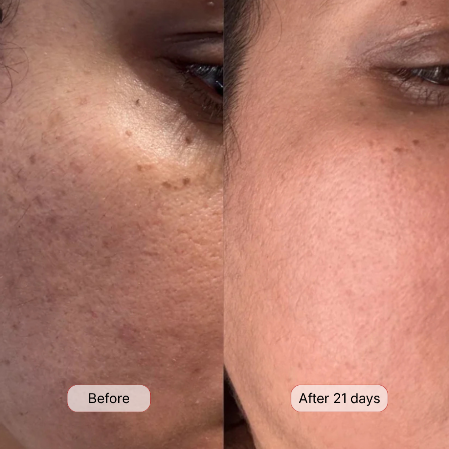 Dark spots & uneven tone.