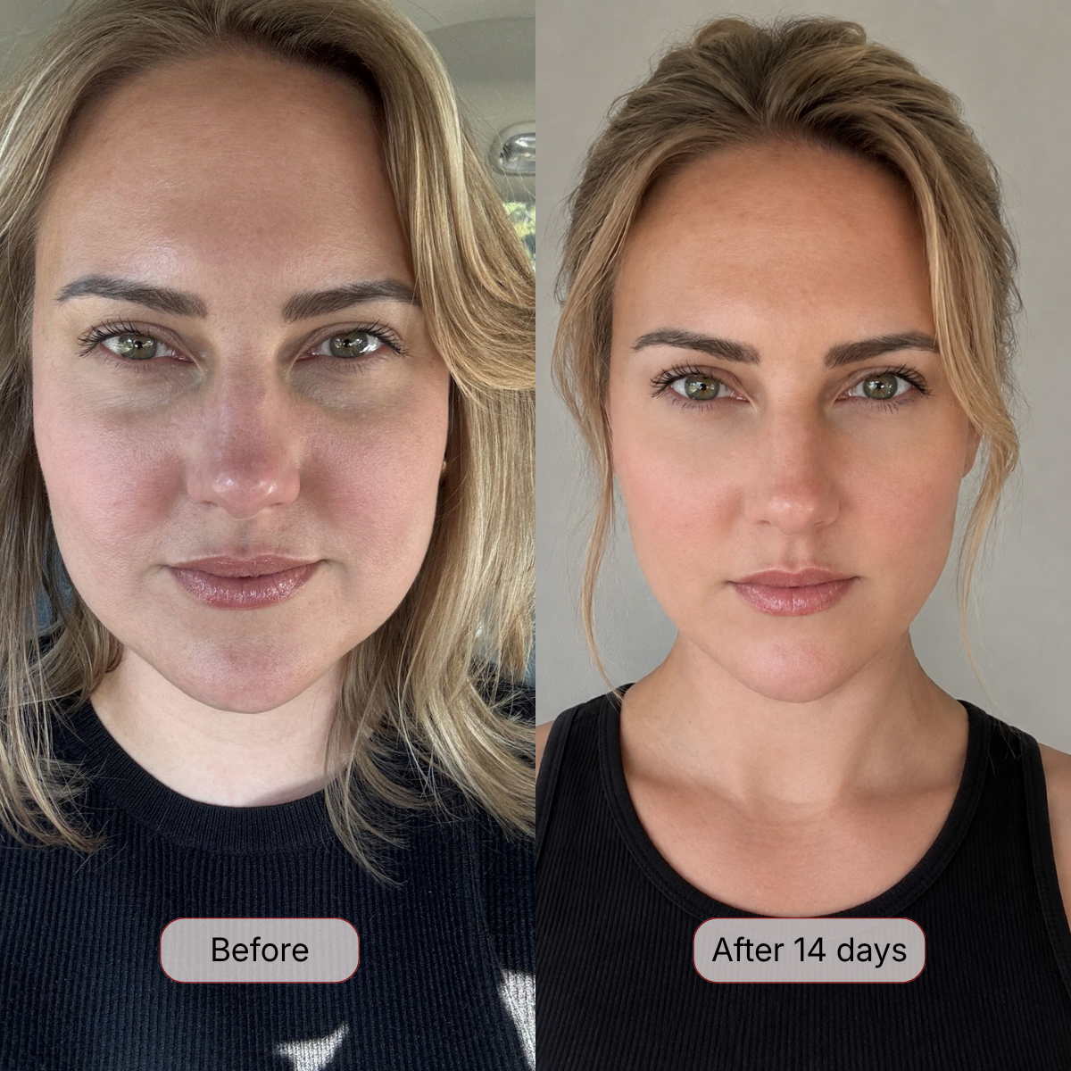 Puffiness & Uneven Skin Tone