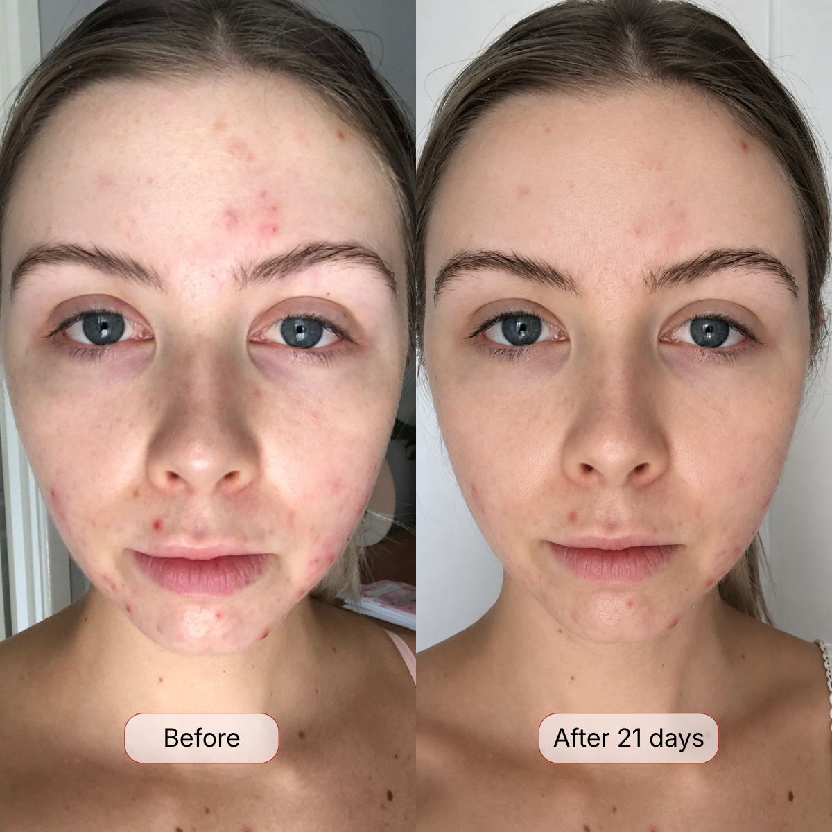 Breakouts & Blemishes