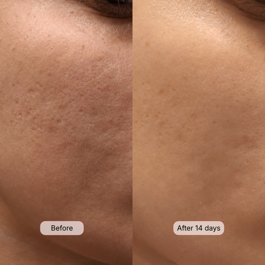 Fine Lines & Loss of Firmness