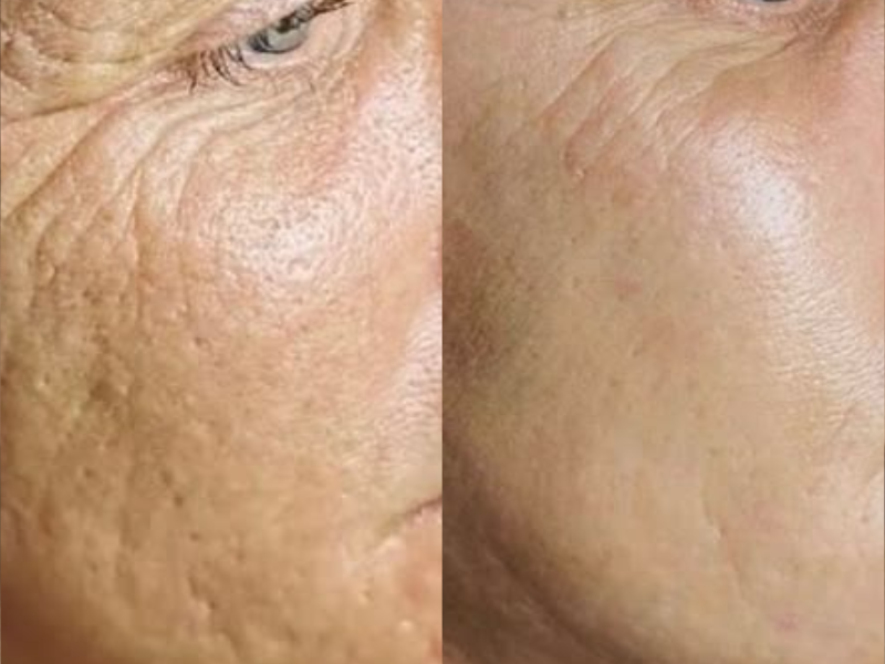 Skin Firmness & Elasticity