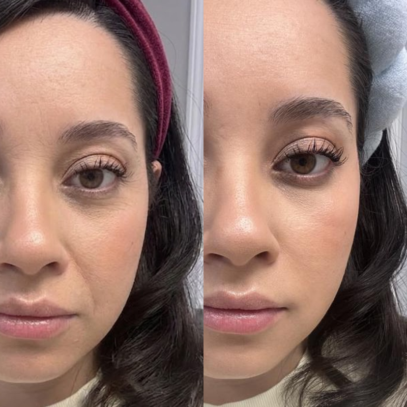 Fine Lines & Firmnes