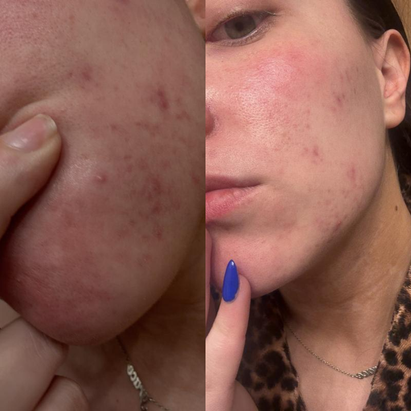 Acne & Clarity