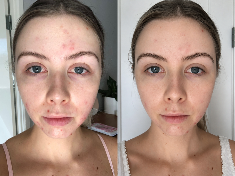 Acne-Prone Skin