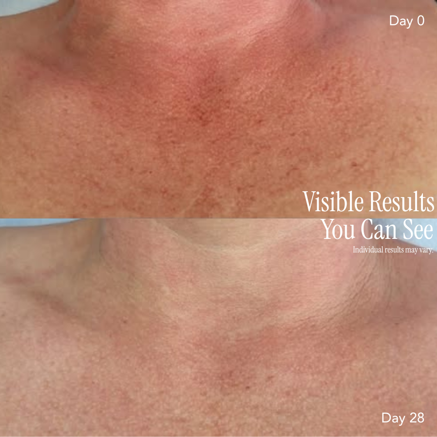 Corique Neck & Chest Pro Light Therapy Mask