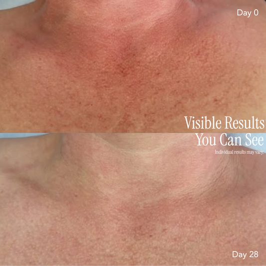 Corique Neck & Chest Pro Light Therapy Mask