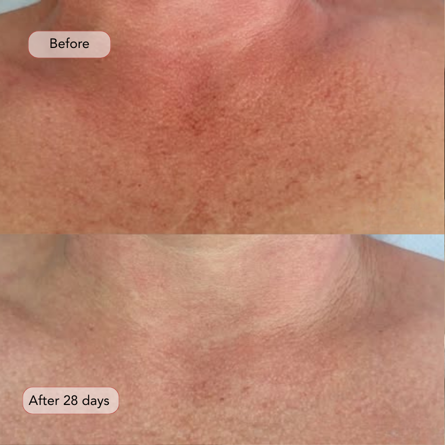 Professional Red Light Therapy Neck & Chest Mask
