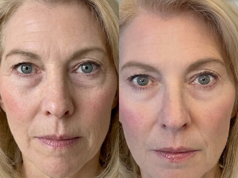 Softer Lines & Firmer-Looking Skin